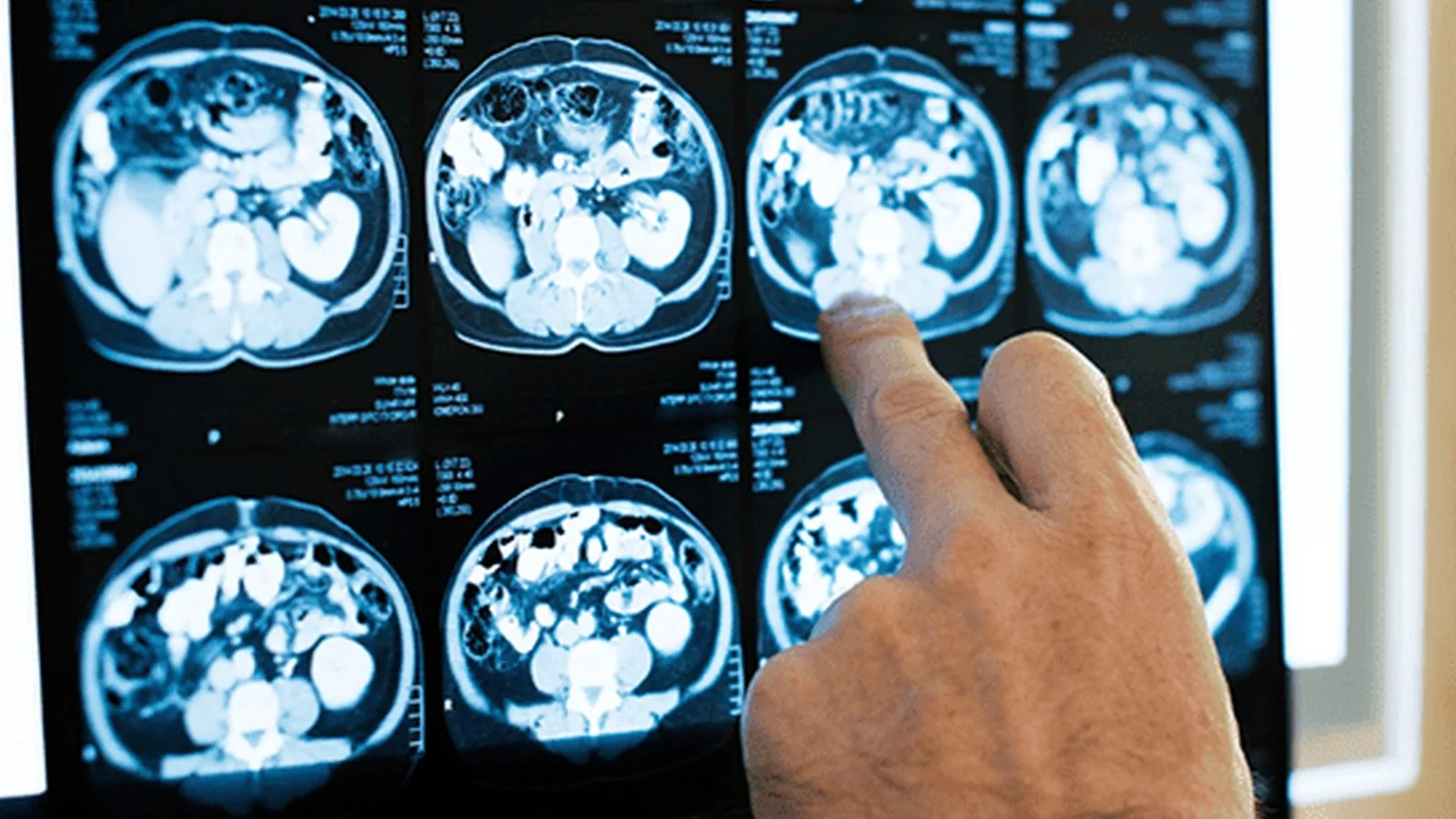 ¿Qué especialista trata la esclerosis múltiple?